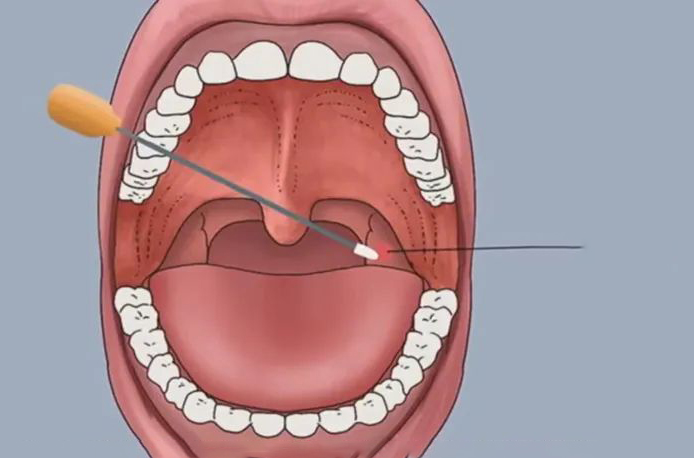 口咽拭子采集口腔樣本圖解