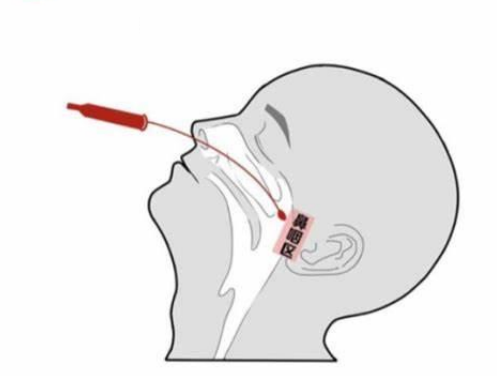 鼻咽拭子采集示意圖