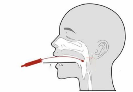 口咽拭子采集示意圖