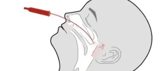 鼻咽拭子的取樣部位