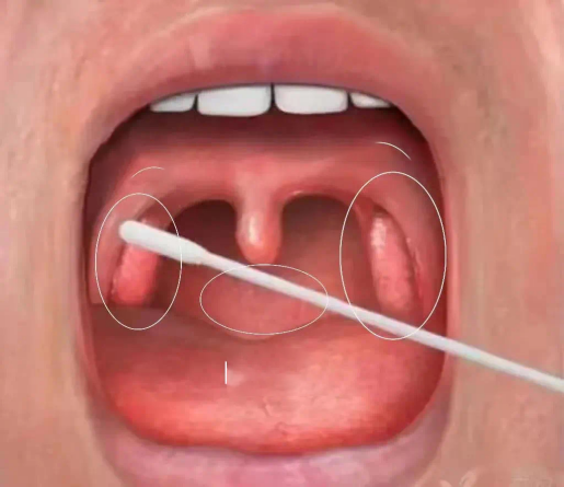 口咽拭子的取樣部位